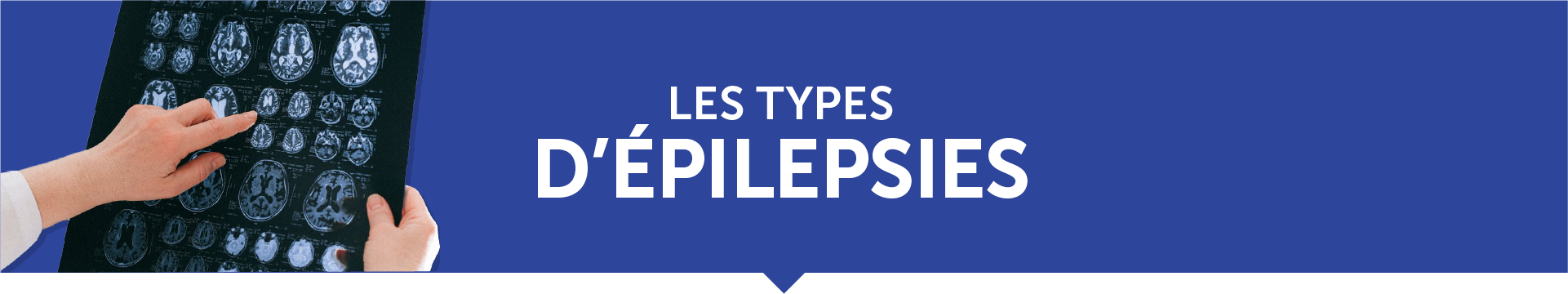 les types d'épilepsies