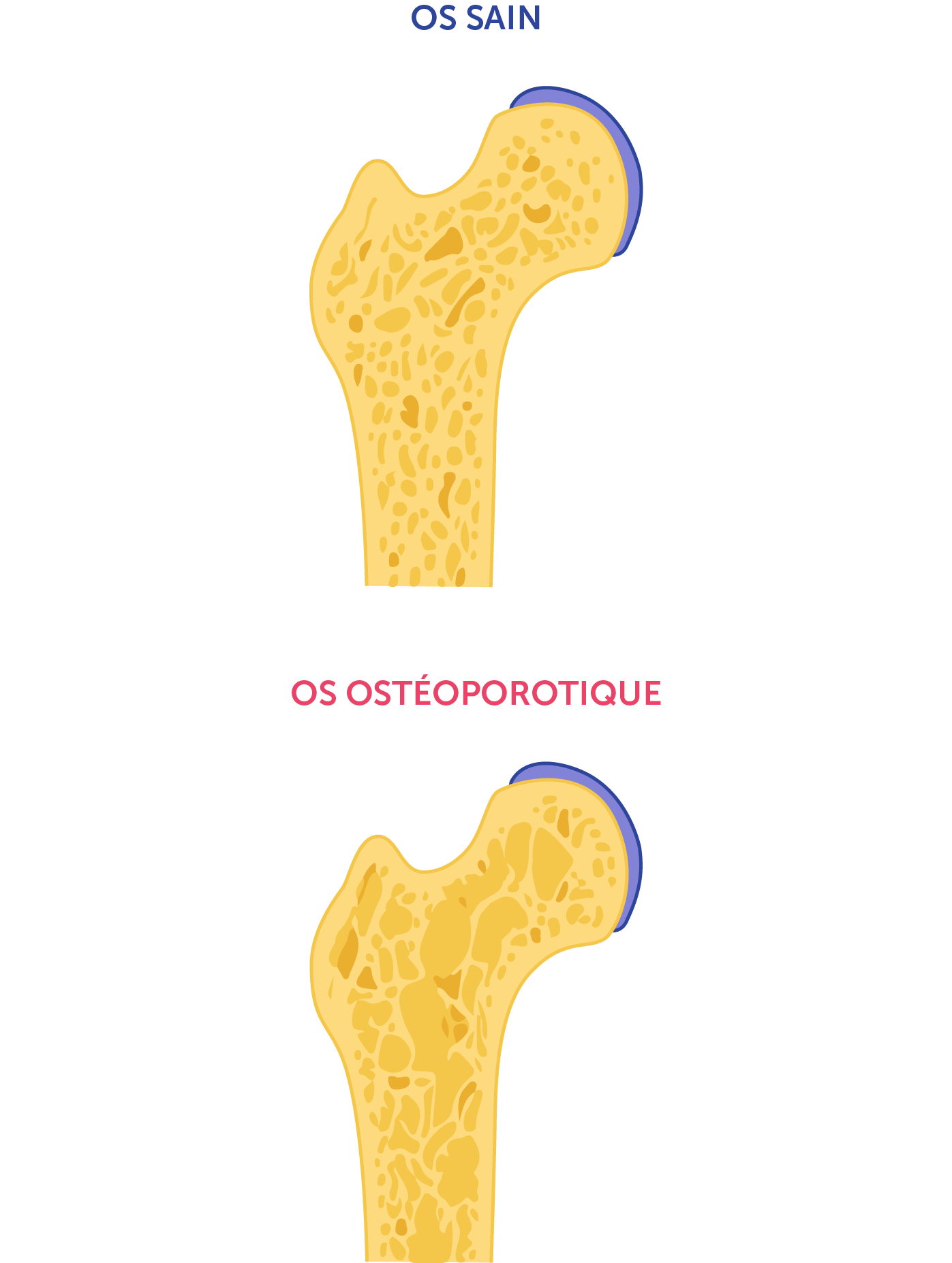 Coupe anatomique schématique d'un os (fémur) 